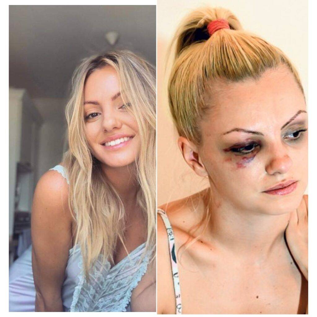 Alexandra Stan l-a iertat pe bărbatul care a bătut-o cu brutalitate. Mărturisirile sale sunt șocante