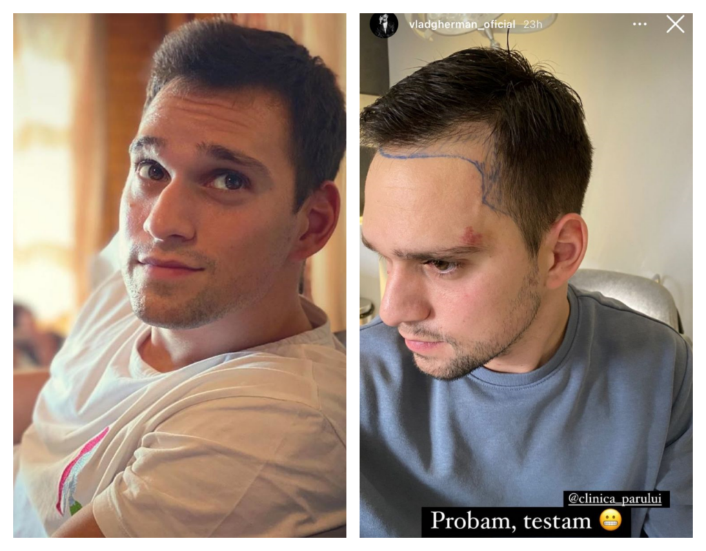 Vlad Gherman, pregătit de o nouă „freză”. Nu duce lipsă de păr în cap, dar actorul merge la o clinică din Constanța