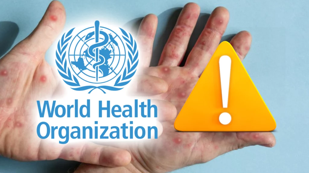 Avertisment OMS! Apare o nouă epidemie din Congo, denumită anterior "variola maimuței"