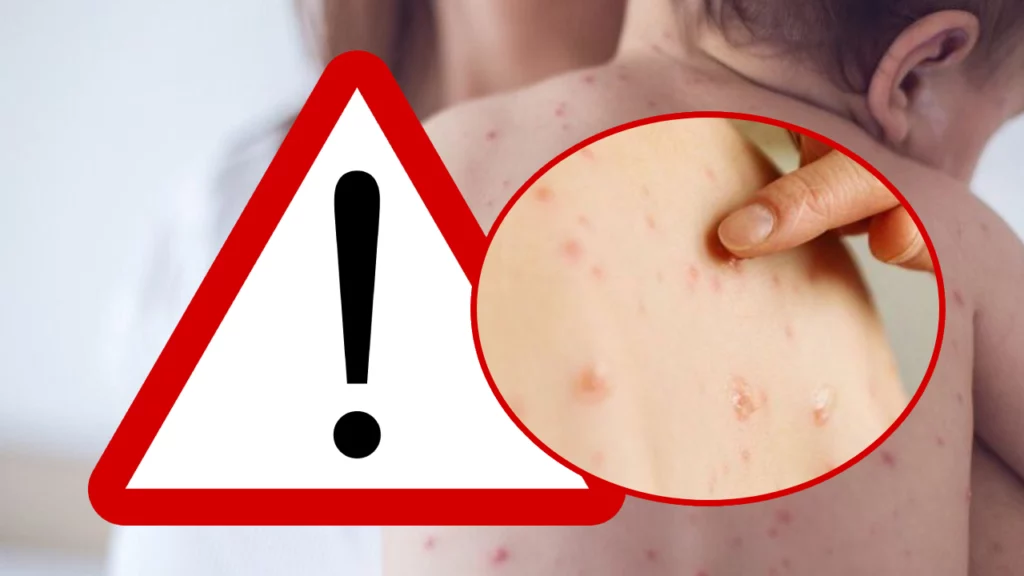 Alertă de sănătate publică! Rujeola se răspândește rapid în România – Ultimele date și măsuri de prevenire