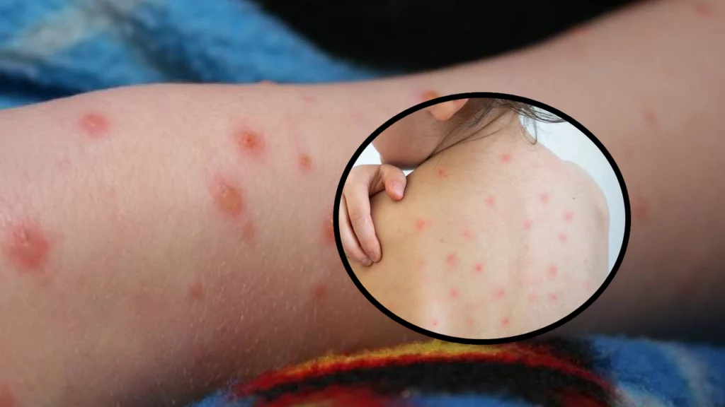 Creștere alarmantă a îmbolnăvirilor de rujeolă la copii în Marea Britanie: Urgența vaccinării